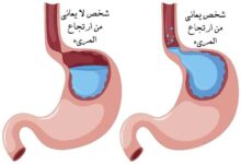 طرق و كيفية علاج ارتجاع المريء نهائيا طرق و كيفية علاج ارتجاع المريء نهائيا