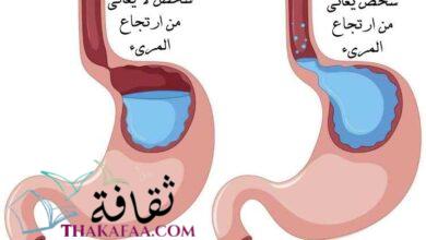 طرق و كيفية علاج ارتجاع المريء نهائيا