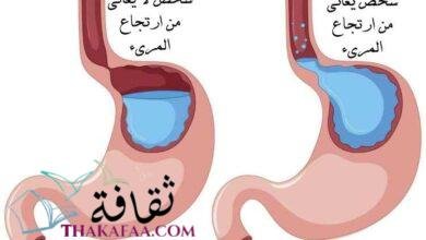 طرق و كيفية علاج ارتجاع المريء نهائيا طرق و كيفية علاج ارتجاع المريء نهائيا