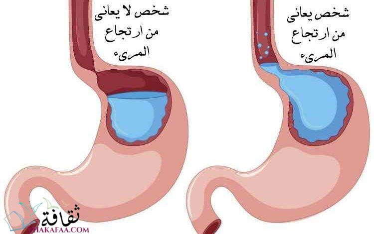 طرق و كيفية علاج ارتجاع المريء نهائيا طرق و كيفية علاج ارتجاع المريء نهائيا