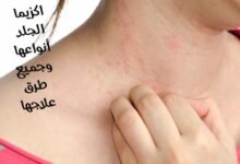أﻫم المعلومات عن الإكزيما : اكزيما الجلد أنواعها وجميع طرق علاجها