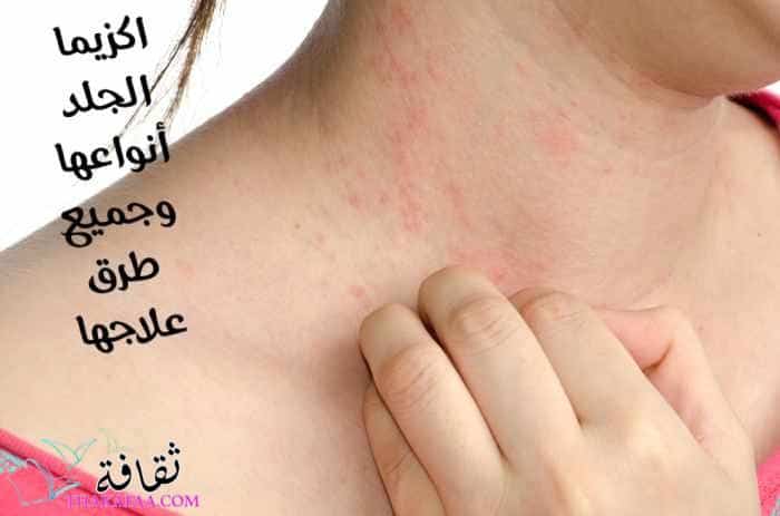 أﻫم المعلومات عن الإكزيما : اكزيما الجلد أنواعها وجميع طرق علاجها أﻫم المعلومات عن الإكزيما : اكزيما الجلد أنواعها وجميع طرق علاجها