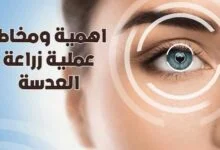 اهمية ومخاطر عملية زراعة العدسة لضعف النظر الشديد 2022 اهمية ومخاطر عملية زراعة العدسة لضعف النظر الشديد 2022