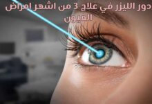 دور الليزر في علاج 3 من اشهر امراض العيون 2022 دور الليزر في علاج 3 من اشهر امراض العيون 2022