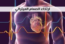 تجربتي مع ارتخاء الصمام الميترالي تجربتي مع ارتخاء الصمام الميترالي