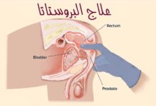 كيف يقوم دكتور المسالك البولية بعلاج البروستاتا