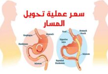 سعر عملية تحويل المسار 2023 مع دكتور أحمد المصري سعر عملية تحويل المسار 2023 مع دكتور أحمد المصري