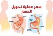 سعر عملية تحويل المسار 2023 مع دكتور أحمد المصري سعر عملية تحويل المسار 2023 مع دكتور أحمد المصري