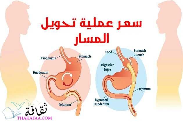 سعر عملية تحويل المسار 2023 مع دكتور أحمد المصري سعر عملية تحويل المسار 2023 مع دكتور أحمد المصري