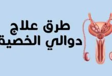 طرق علاج دوالي الخصية 2023 مع دكتور أسامة حتة