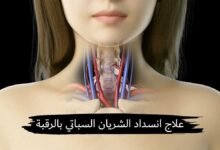 أفضل علاج انسداد الشريان السباتي بالرقبة الدكتور حسام المهدي أفضل علاج انسداد الشريان السباتي بالرقبة الدكتور حسام المهدي