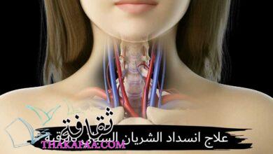 أفضل علاج انسداد الشريان السباتي بالرقبة الدكتور حسام المهدي