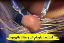 استئصال أورام البروستاتا بالروبوت مع الدكتور محمود عبد الحكيم استئصال أورام البروستاتا بالروبوت مع الدكتور محمود عبد الحكيم
