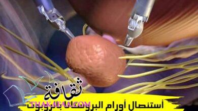 استئصال أورام البروستاتا بالروبوت مع الدكتور محمود عبد الحكيم استئصال أورام البروستاتا بالروبوت مع الدكتور محمود عبد الحكيم