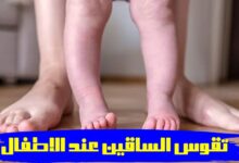 هل يوجد علاج لتقوس الساقين عند الاطفال؟- دكتور ابراهيم حنتيرة 