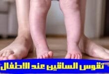 هل يوجد علاج لتقوس الساقين عند الاطفال؟- دكتور ابراهيم حنتيرة هل يوجد علاج لتقوس الساقين عند الاطفال؟- دكتور ابراهيم حنتيرة
