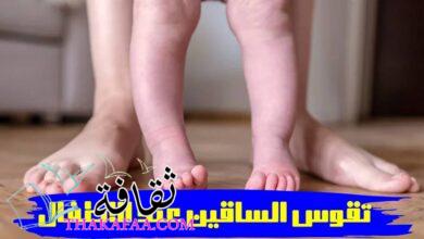 هل يوجد علاج لتقوس الساقين عند الاطفال؟- دكتور ابراهيم حنتيرة  هل يوجد علاج لتقوس الساقين عند الاطفال؟- دكتور ابراهيم حنتيرة