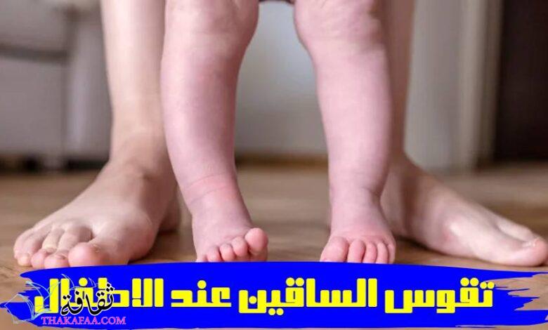 هل يوجد علاج لتقوس الساقين عند الاطفال؟- دكتور ابراهيم حنتيرة هل يوجد علاج لتقوس الساقين عند الاطفال؟- دكتور ابراهيم حنتيرة