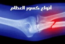 أنواع كسور العظام وأهم طرق العلاج والوقاية أنواع كسور العظام وأهم طرق العلاج والوقاية